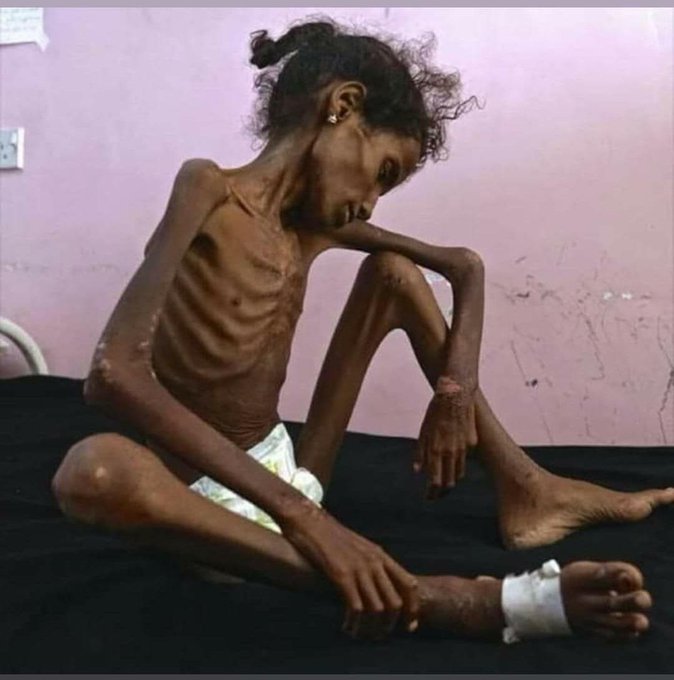شاهد.. مذيعة شهيرة تنشر صورة مؤلمة لفتاة يمنية بدون ملابس وتعلق عليها بهذه الكلمات!